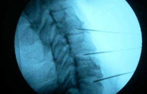 Bloqueos facetarios córtico anestésicos y con ozonoterapia